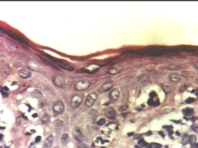 Fig.1: ATLL, Biopsia Cutnea. H-E - <div style=